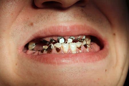 amelogenesis imperfecta