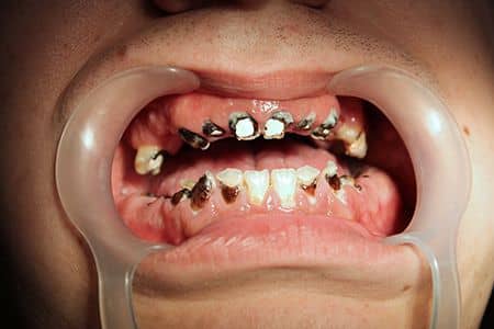 amelogeneza imperfecta