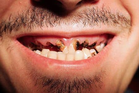 amelogeneza imperfecta