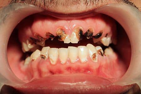 amelogeneza imperfecta