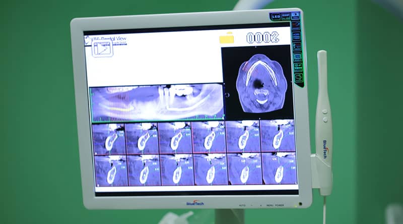 Implant Dentar Coroane Zirconiu Dentist