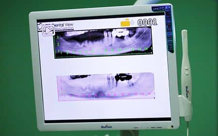 Camera Intraorala Stomatologie