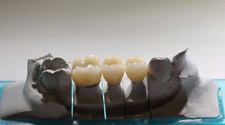 Coroane Dentare din Zirconiu