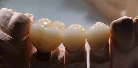 coroane dentare din oxid de zirconiu
