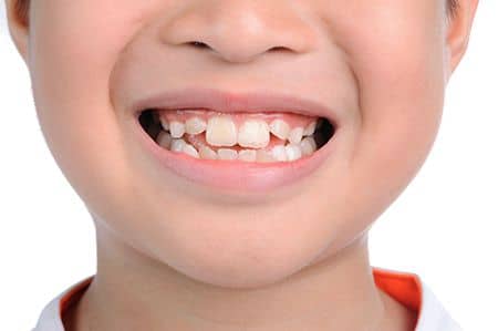 dinti permanenti in crestere