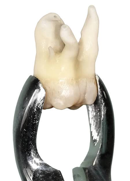 extractie dentara molar de minte