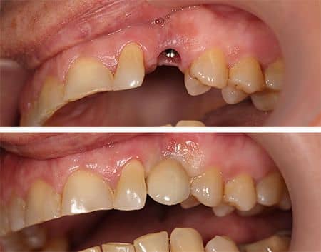 Implant dentar protezat in dreptul Caninului