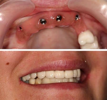 Punte dentara ceramica pe Implanturi