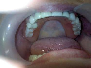 proteza dentara flexibila