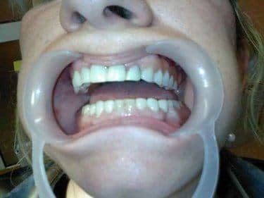 proteza dentara flexibila