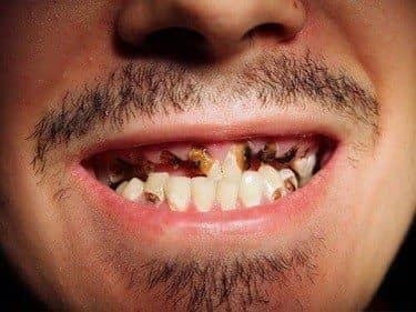 Amelogeneza imperfecta