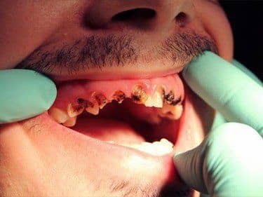 Amelogenesis imperfecta