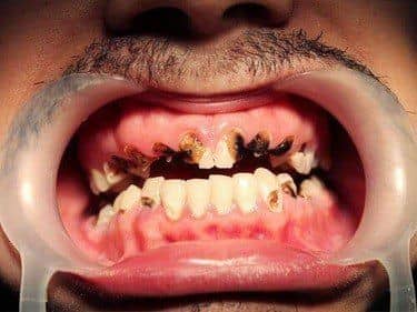 Amelogeneza imperfecta