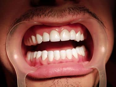 Coroane din zirconiu