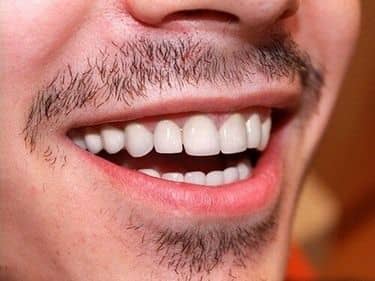 pacient cu coroane din full-Zirconiu Piata Muncii