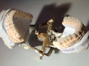 lucrari dentare din zirconiu pe model de lucru