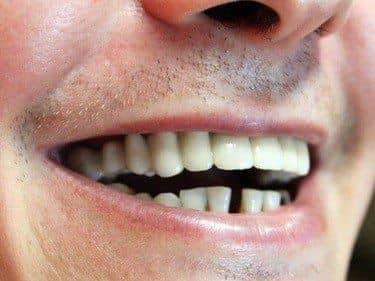 lucrare dentara portelan