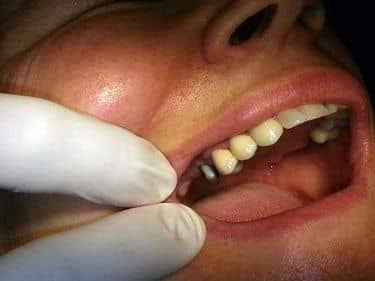 caz clinic stomatologie implant dentar