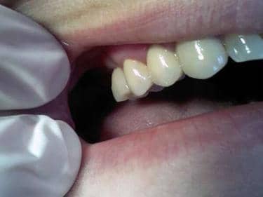 caz clinic stomatologie implant dentar