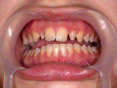 Incisivi laterali nanici