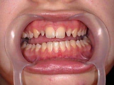 Incisivi laterali foarte mici