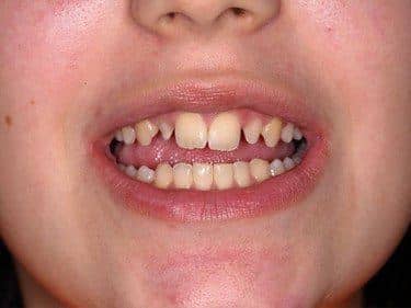 Microdonție localizată (focală)