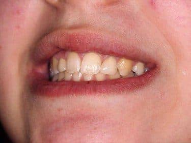 coroane dentare zirconiu