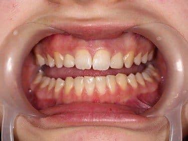 Incisivi laterali proporționați