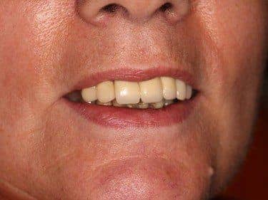 lucrare dentara portelan