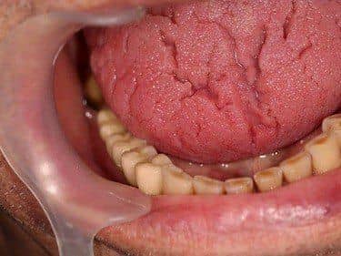 punte metalo-ceramica