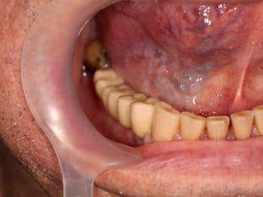 lucrare protetica fixa