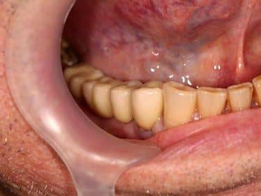 lucrare dentara portelan