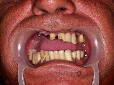 edentatie terminala extinsa