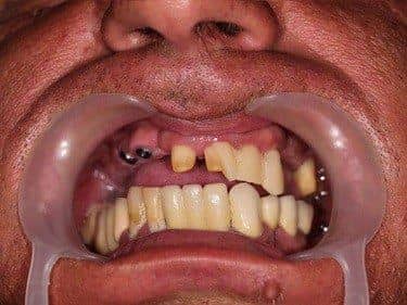 lucrare protetică fracturată