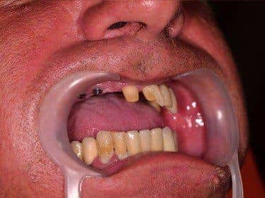 ineficienta masticatorie