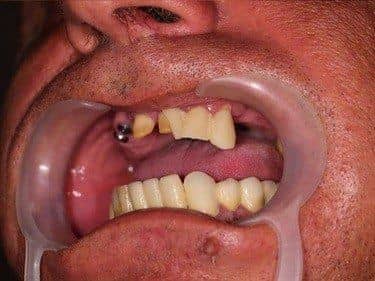 Edentație terminală și intercalată