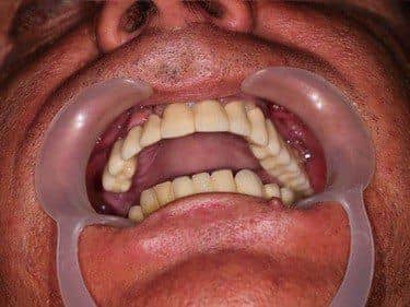 lucrare protetica refacuta