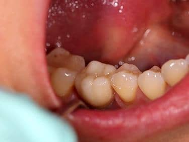 coroană metalo-ceramică