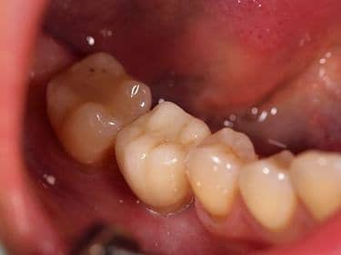 coroană metalo-ceramică