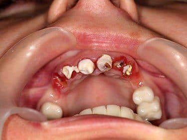 resturi radiculare irecuperabile