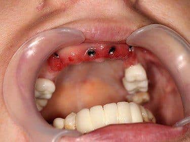 implanturi dentare inserate post-extracțional