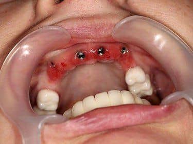 implanturi dentare inserate post-extracțional