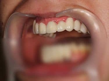 punte dentară fixă din Zirconiu