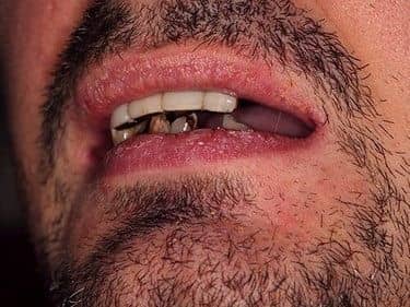 resturi radiculare irecuperabile