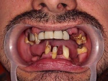 lucrari dentare vechi