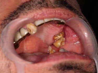 lucrari dentare vechi