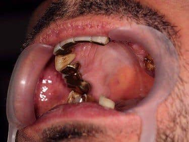 lucrari dentare vechi