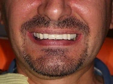 punte dentară fixă din porțelan