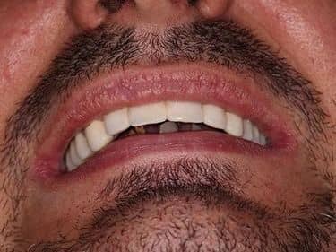 punte dentară fixă din porțelan