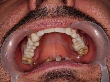 punte dentară fixă din porțelan